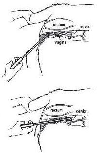 Two views of the CIDR applicator being inserted into the vagina.