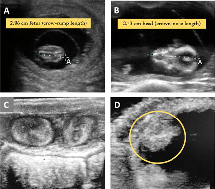 Four ultrasound observations.