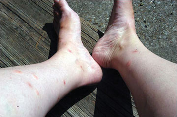 Fleas often target the legs and ankles